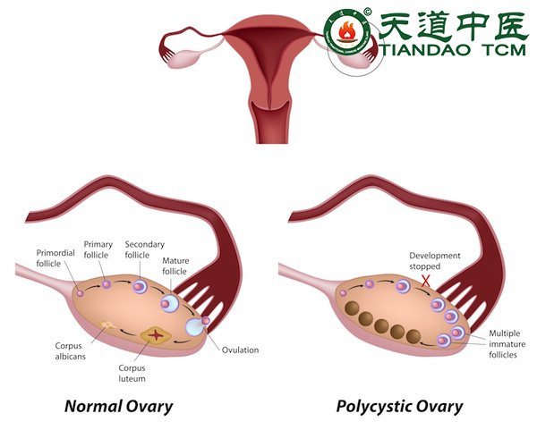 Polycystic infertility
